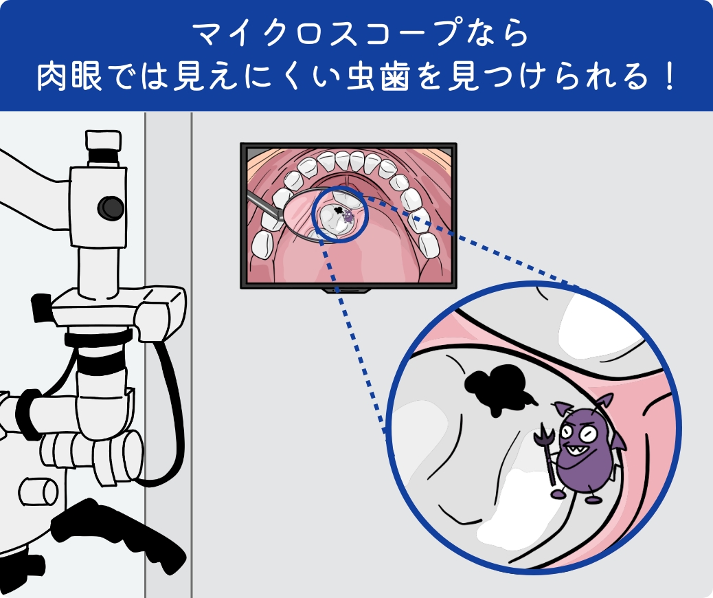 マイクロスコープなら肉眼では見えにくい虫歯を見つけられる！