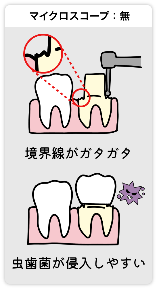 マイクロスコープ無しだと歯の境界線がガタガタで虫歯菌が侵入しやすい