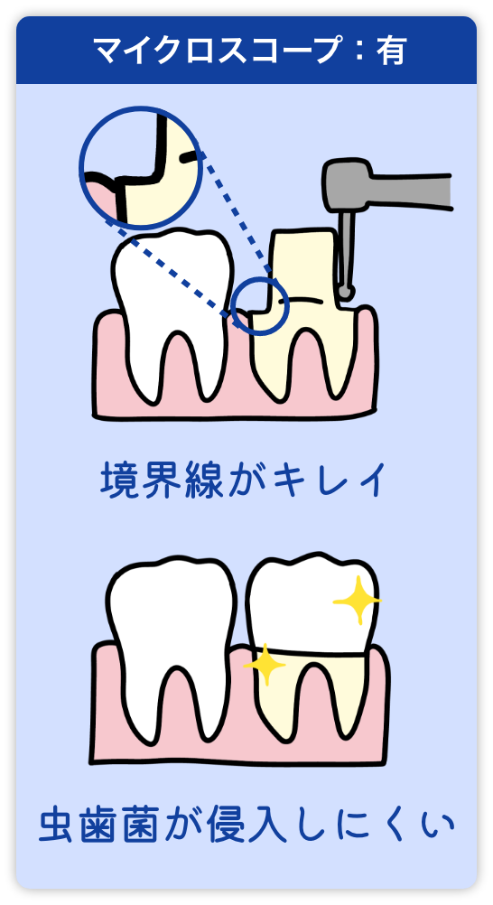 マイクロスコープ有りだと歯の境界線がキレイで虫歯菌が侵入しにくい