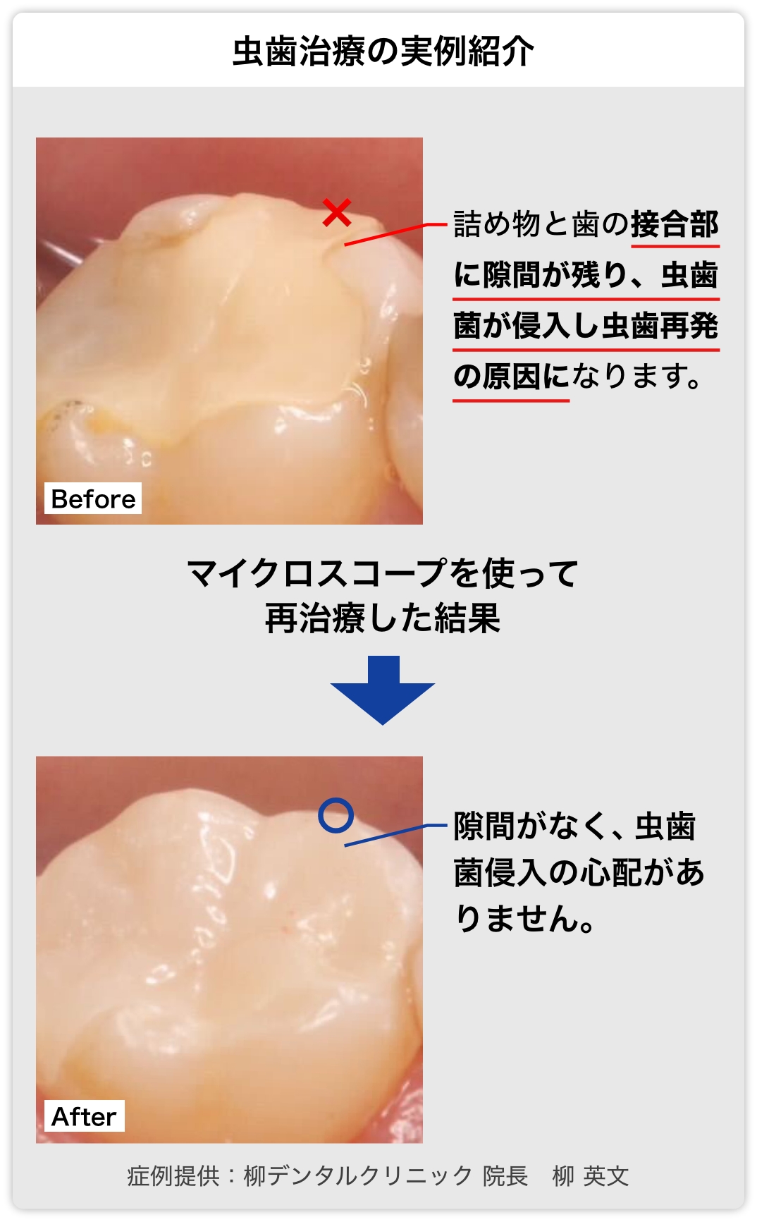 虫歯治療の実例紹介